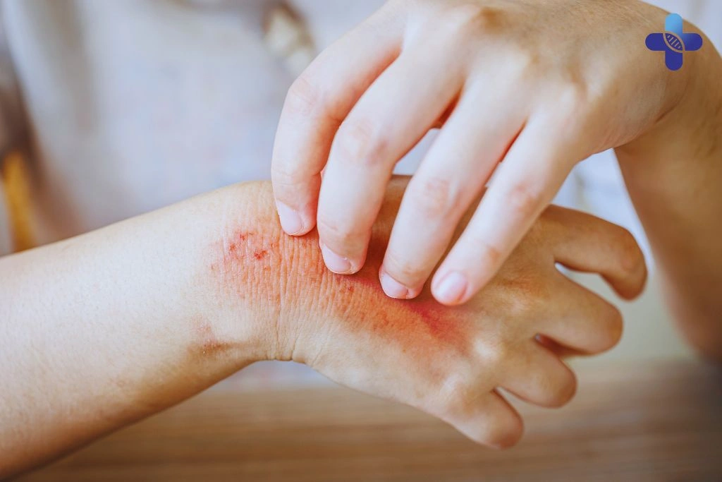 How to Prevent Prickly Heat in Bali