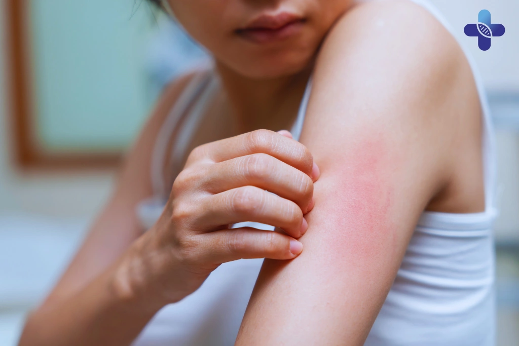 The 7 Telltale Symptoms of Dengue Fever