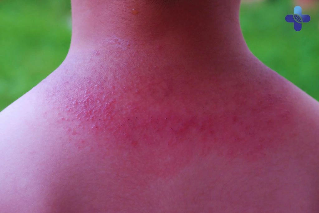 Treatment for Prickly Heat