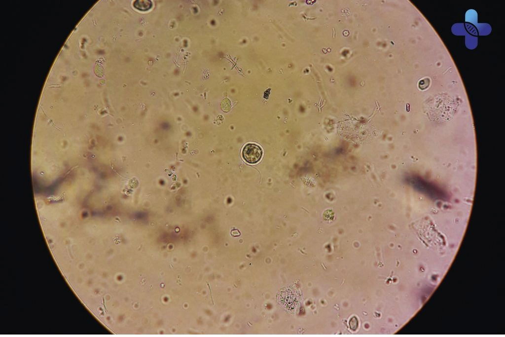 Comprehensive Guide to Trichomonas Vaginalis in Bali Symptoms, Risks, Prevention, and Effective Treatment