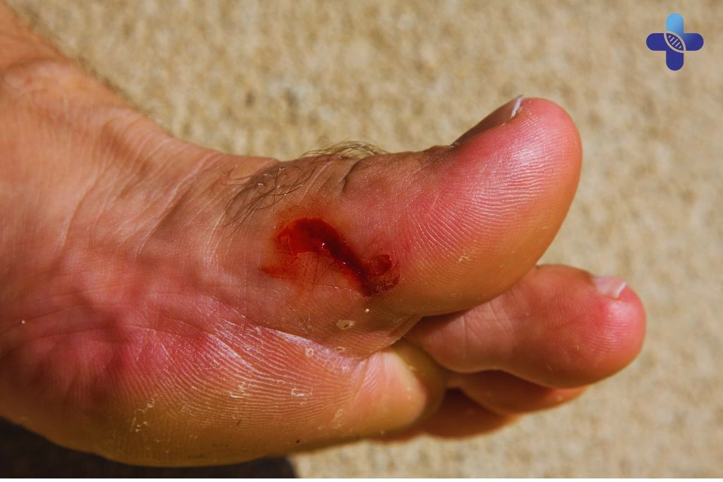Infected Coral Scratches in Bali What You Need to Know Before It Gets Worse