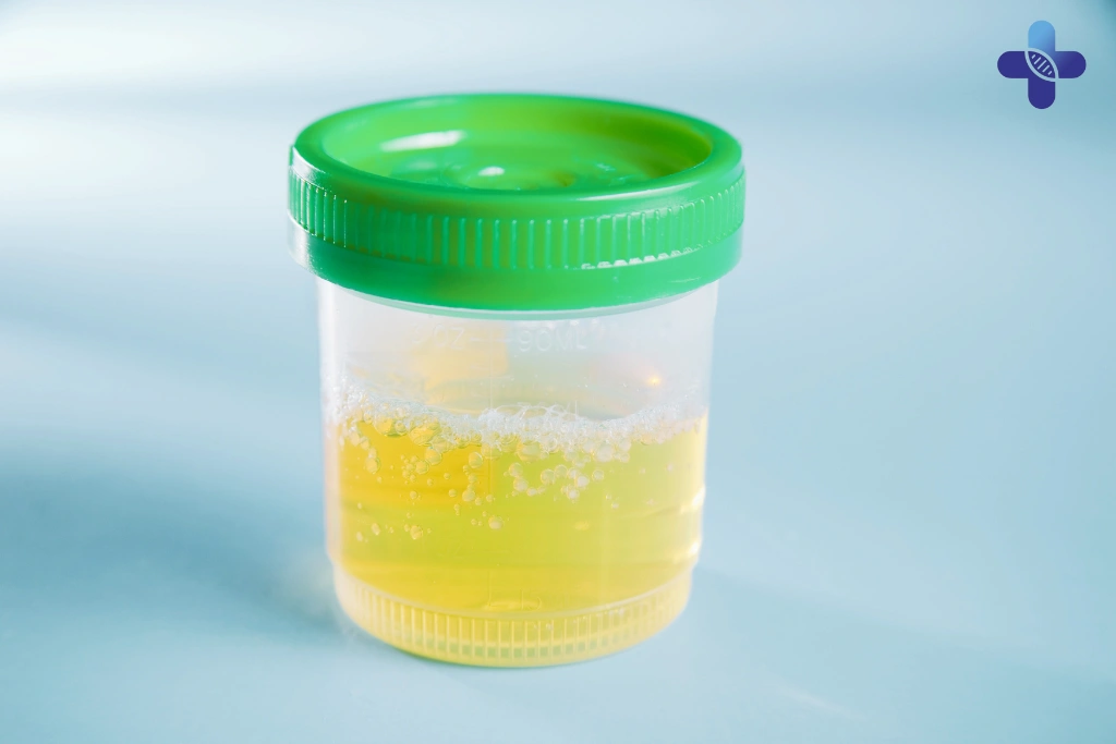 Common Causes of Cloudy Urine