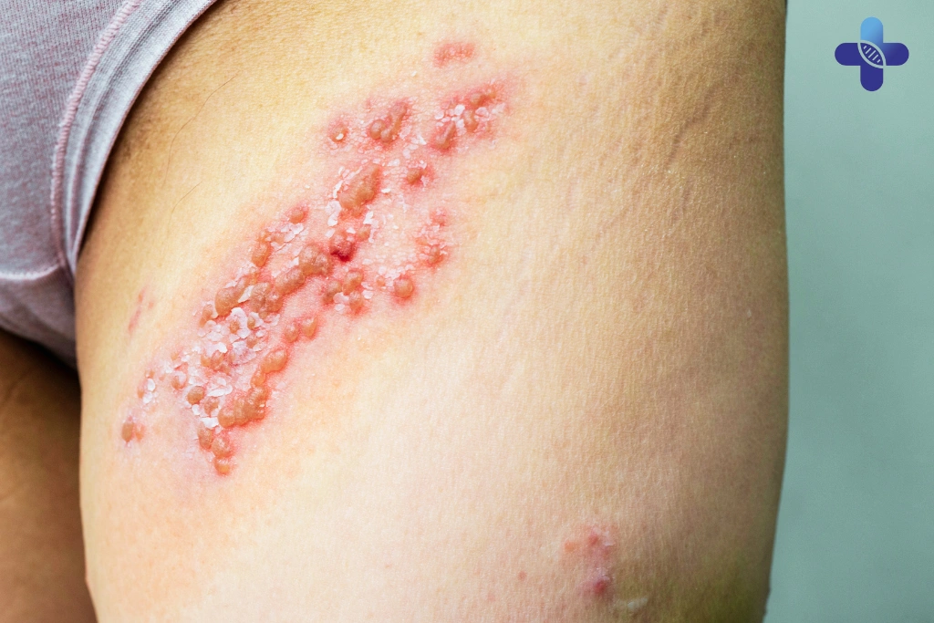 Possible STD-Related Skin Conditions
