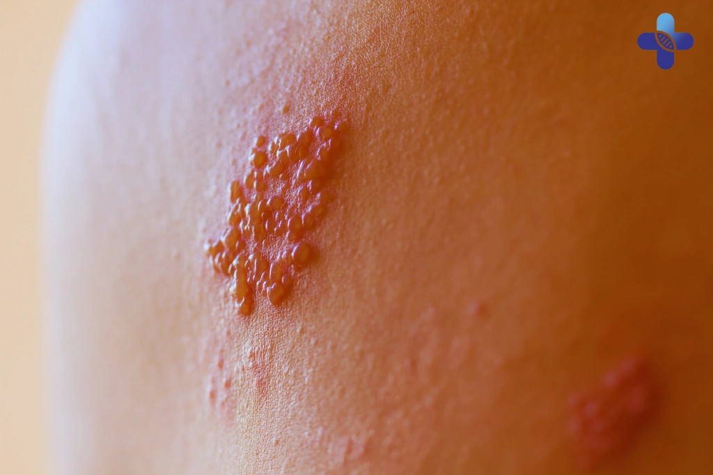 Should You Be Worried_ Early Signs of STI Most People Ignore