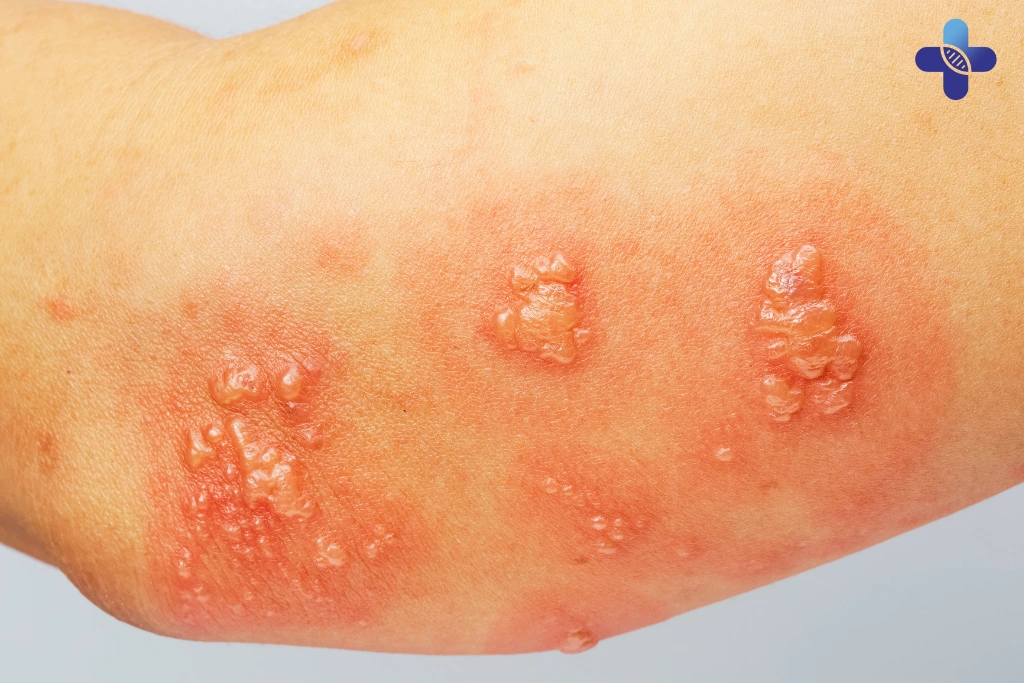 Types of STD-Related Rashes