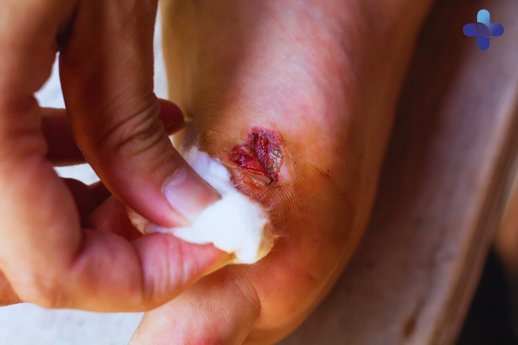 Is Your Bali Wound Infected_ A Doctor Explains 5 Signs to Look For