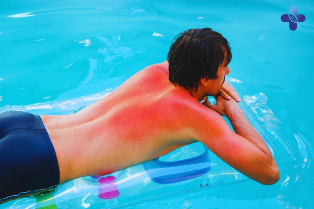 Severe Sunburn in Bali_ A Doctor's Guide to Treating Blisters, Pain & Sun Poisoning