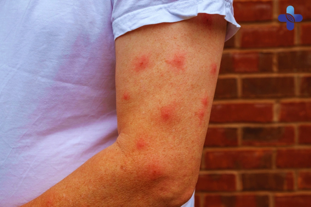The Main Mosquito-Borne Illnesses in Bali