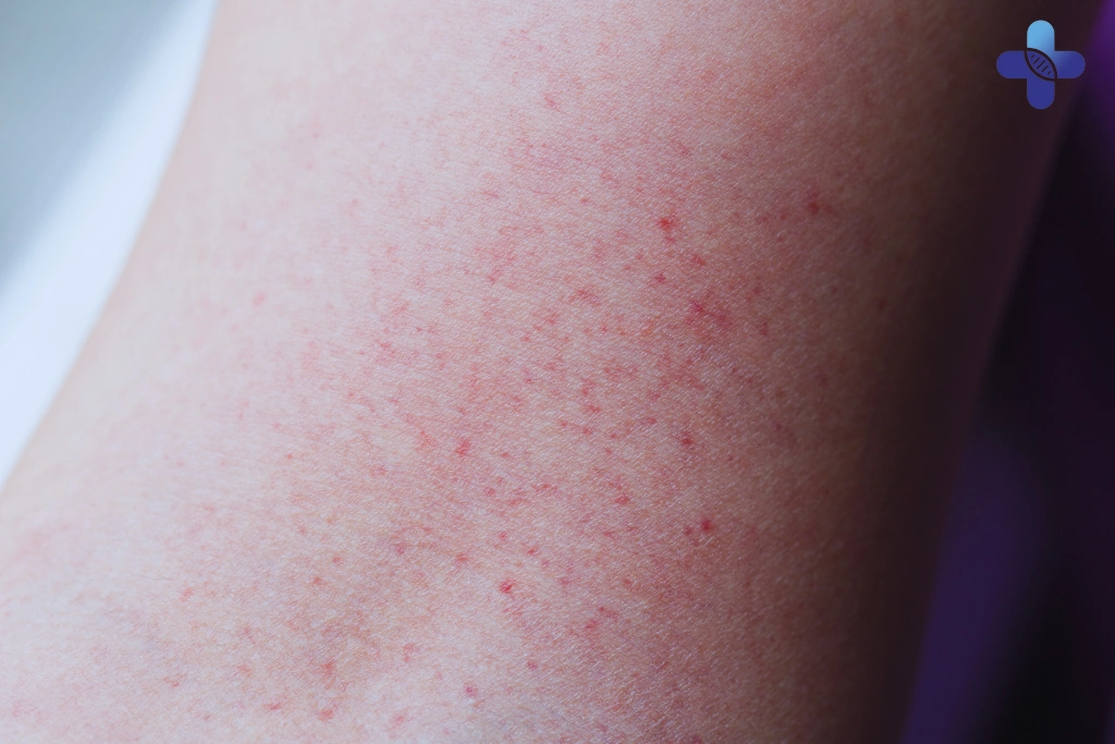 Understanding Fever with Skin Rash in Bali