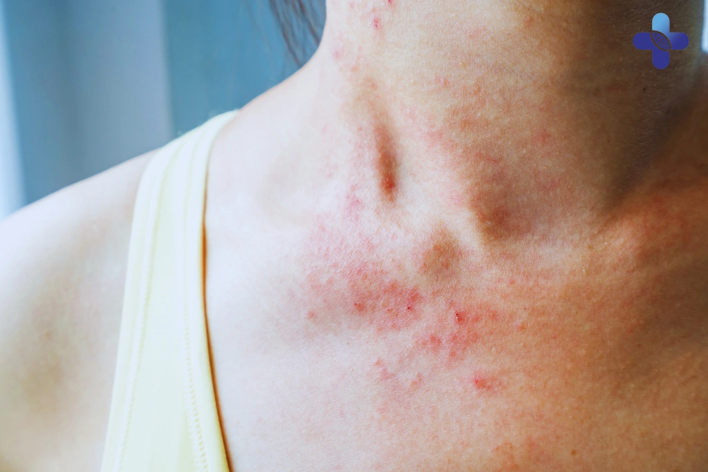 Why Skin Rash with Fever Should Not Be Ignored