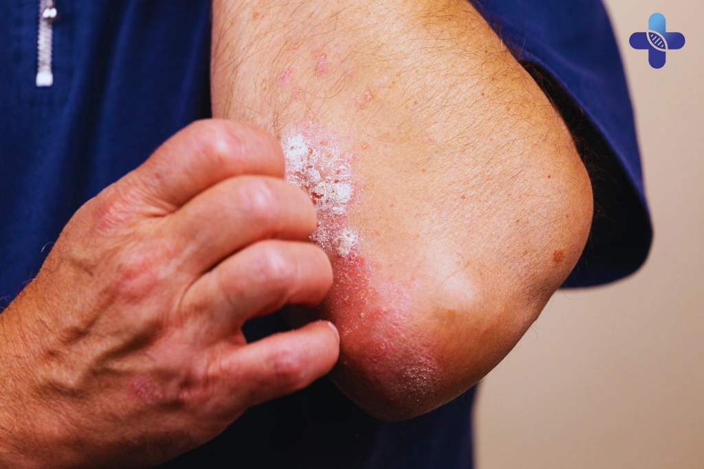 Why Sudden Skin Rash with Fever Needs Attention in Bali