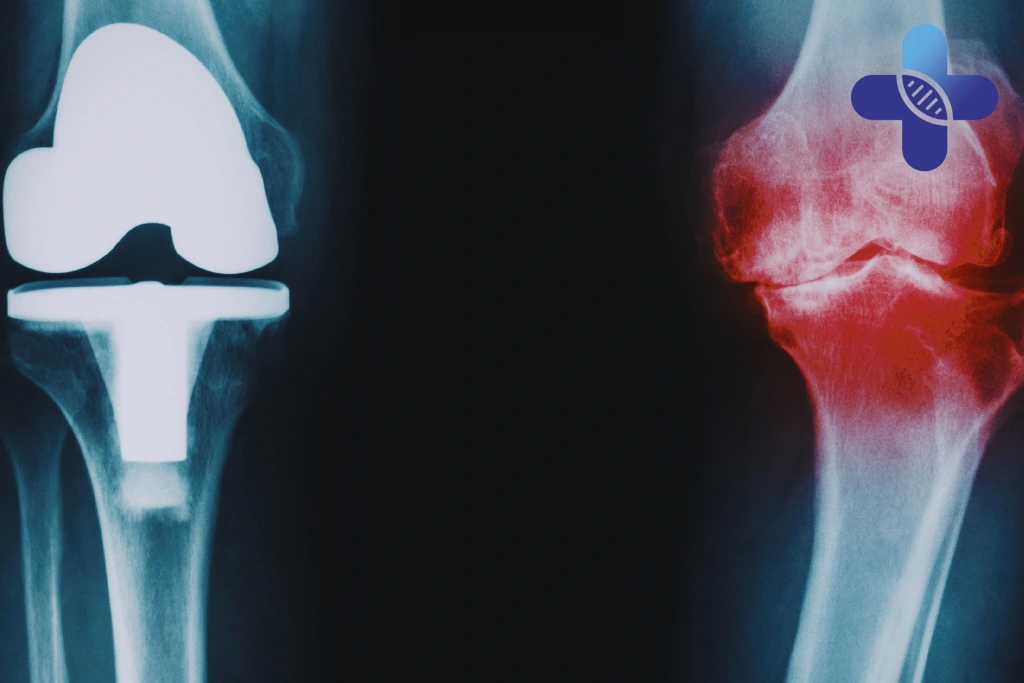 Conclusion - Knee Pain Treatment in Bali Options Beyond Painkillers