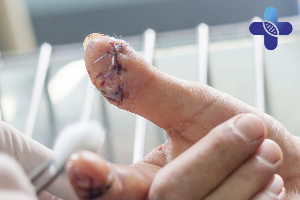 Early Warning Signs Travelers Shouldn’t Ignore When Dealing With Wounds in Bali