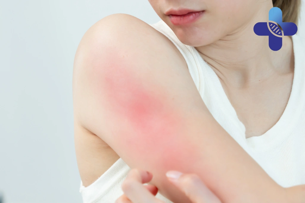 Is It Normal for Small Skin Breaks to Look Redder in Bali’s Climate