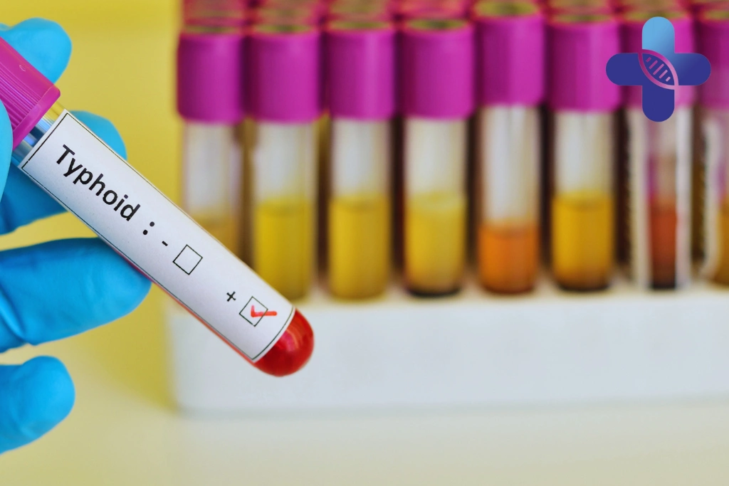 Medical Tests for Typhoid in Bali_ What Travelers Should Expect