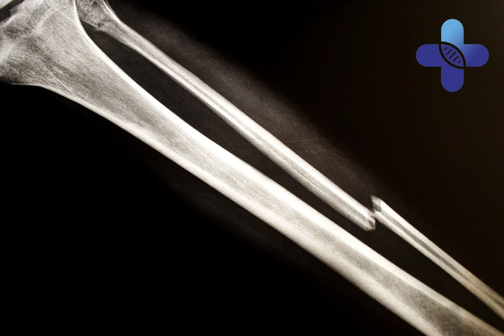 Broken Bone in Bali_ When Travelers May Need Ambulance Support After a Fall, Crash, or Serious Injury