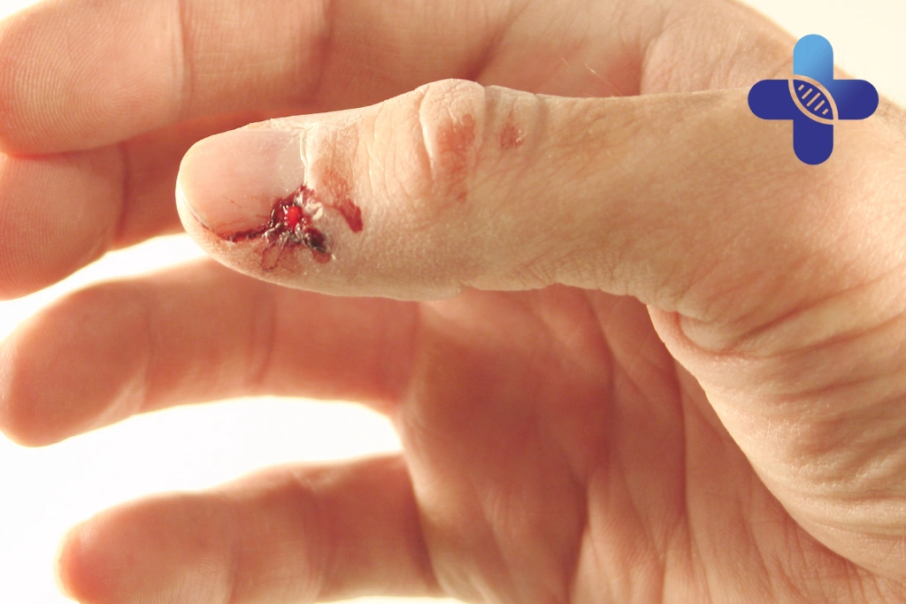 Minor Wound Care in Sanur_ When Travelers Need Medical Attention