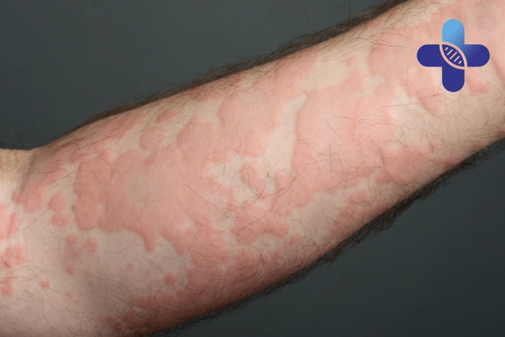 Rash, Insect Bites, and Outdoor Exposure