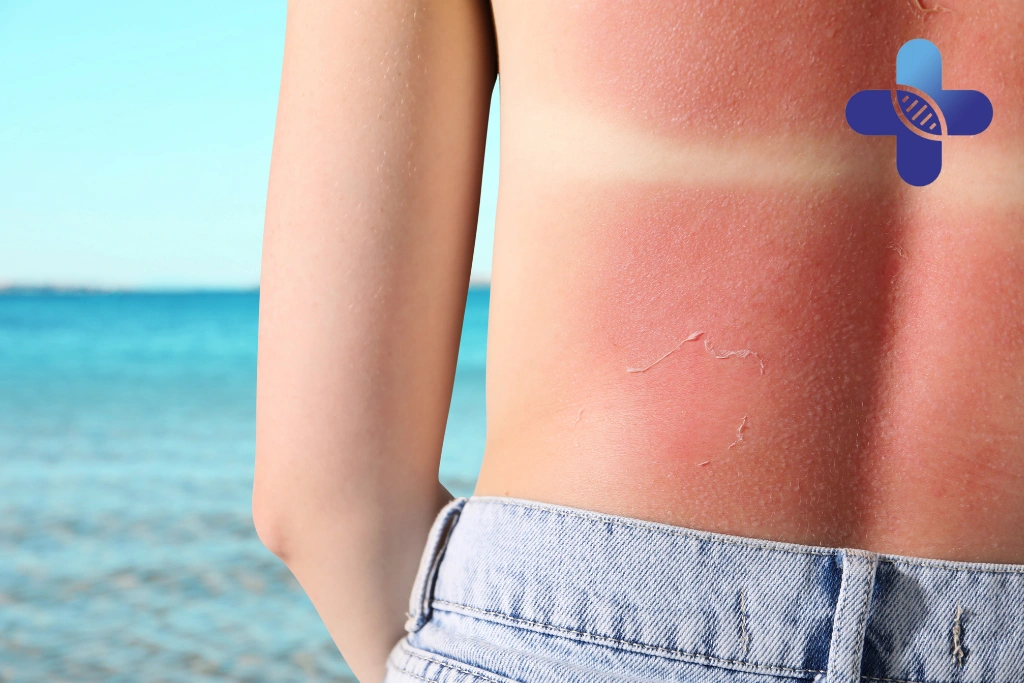 Severe Sunburn Treatment Jimbaran Bali