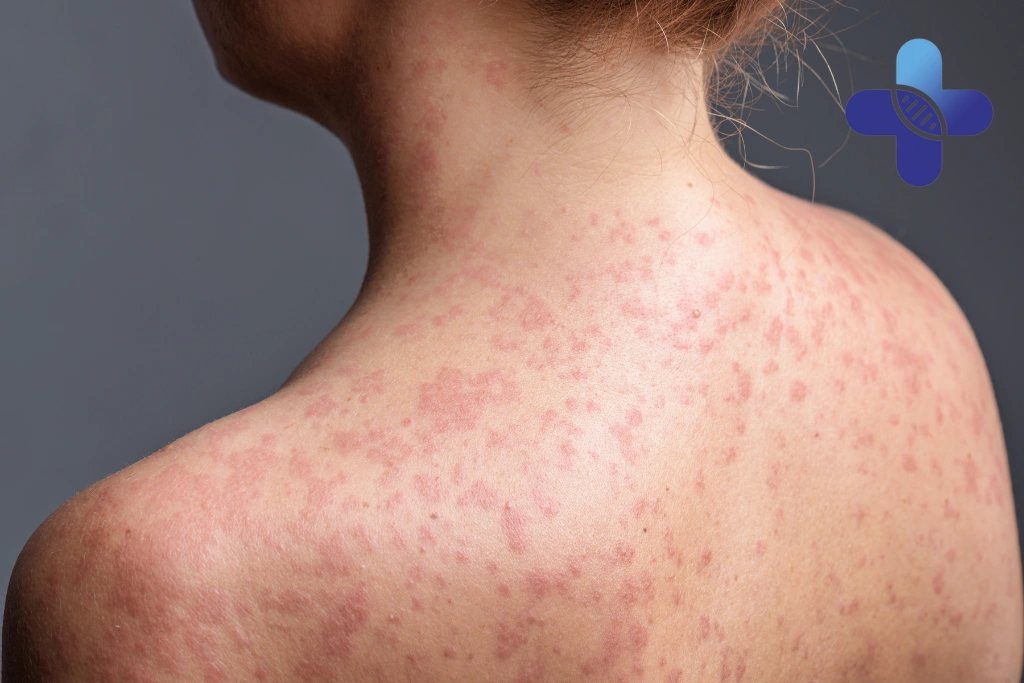 Skin Rash After Snorkeling Jimbaran Bali