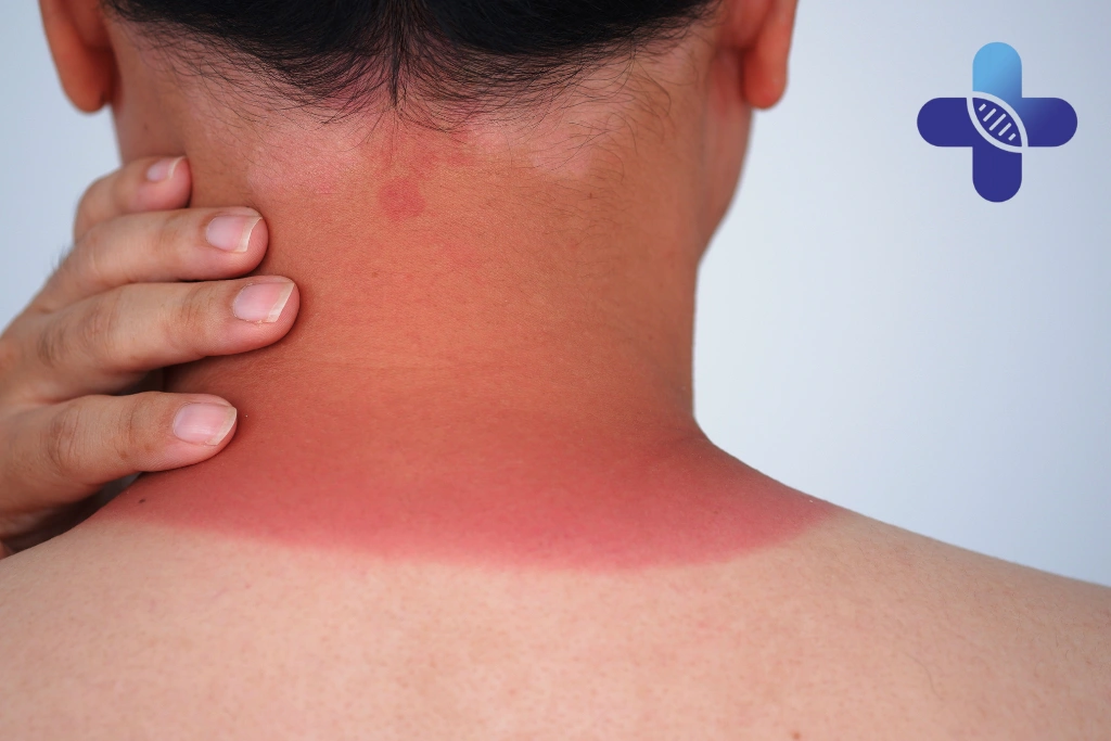 What a Doctor May Check During a Sunburn Consultation