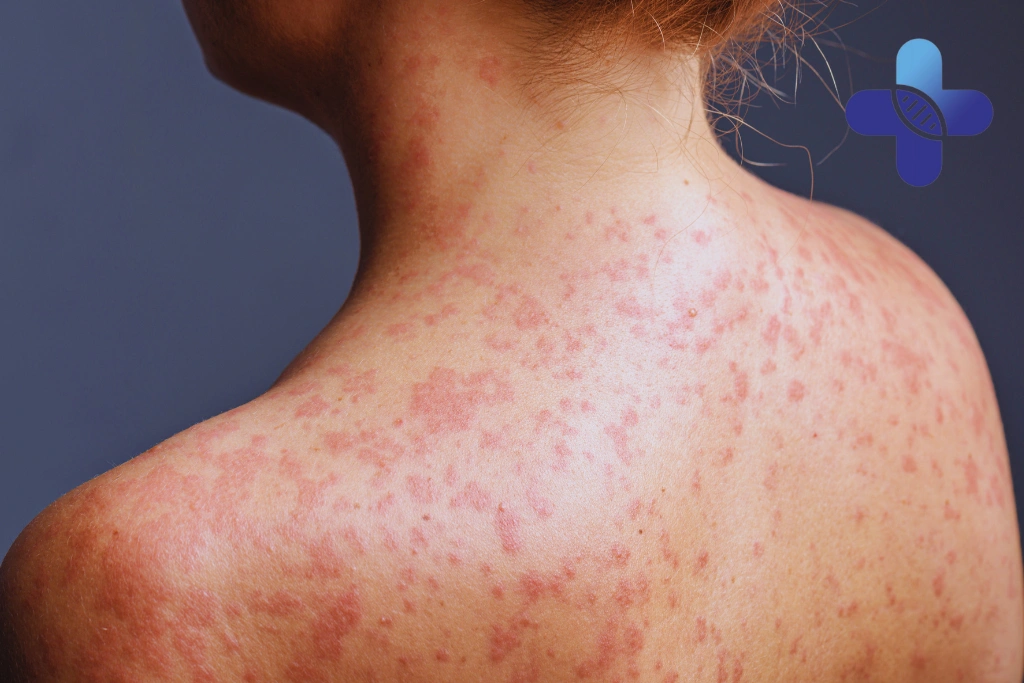 Home Care for Heat Rash