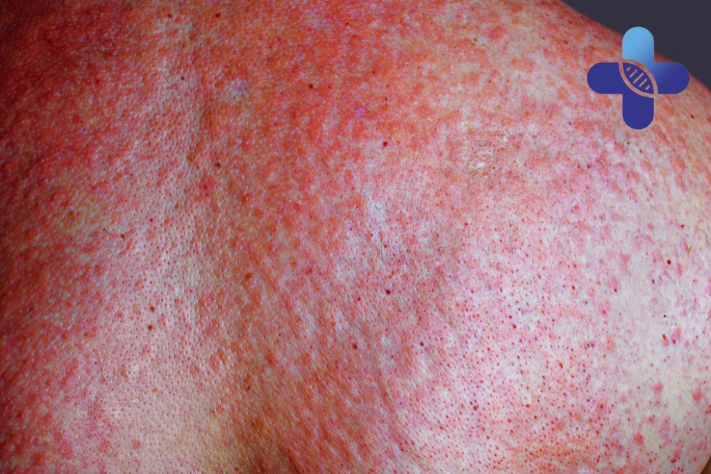 Persistent Rashes and Heat Bumps in Bali_ When to Worry